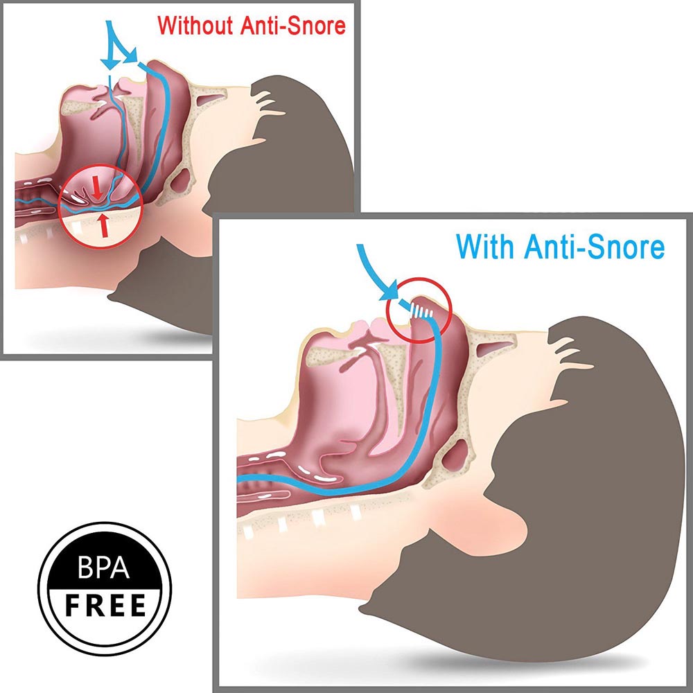 Anti Ngorok Pernafasan Hidung Stop Snoring Solution - Blue