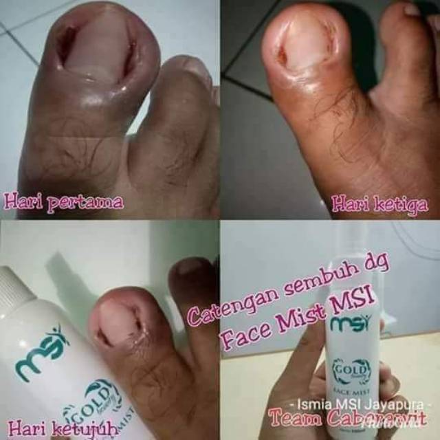 

Facemist ampuh menagtasi jerawat dan flek hitam