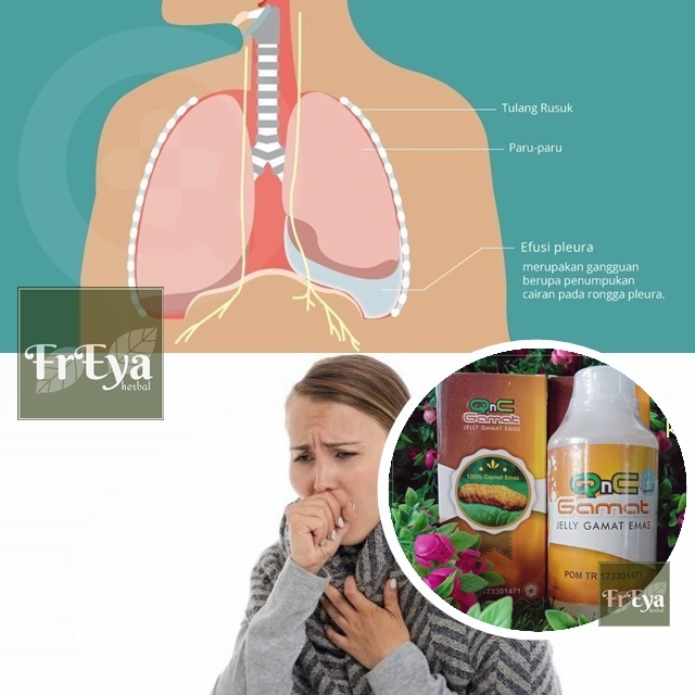 OBAT EFUSI PLEURA, OBAT HERBAL PENUMPUKAN CAIRAN DI PELURA, OBAT PLEURA BERAIR, OBAT CAIRAN DI PLEUR