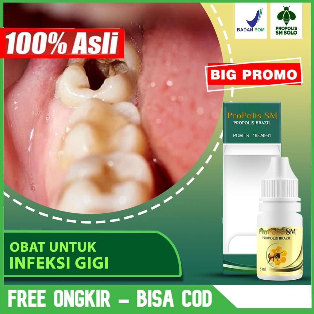 Obat Infeksi Gigi - Abses Gigi - Sakit Gigi - Radang Gusi, Pencegah Gigi Berlubang Propolis Sm SOLO