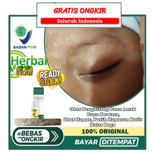 Obat Penghilang Panu Anak - Bayi, Obat Panu Dewasa, Obat Hapur, Menghilangkan Putih Hapuran Kulit, O