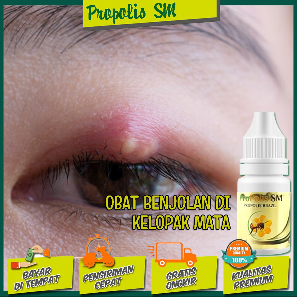 Obat Benjolan di Kelopak Mata / Benjolan Kalazion / Kalazion Bengkak Walatra Propolis SM