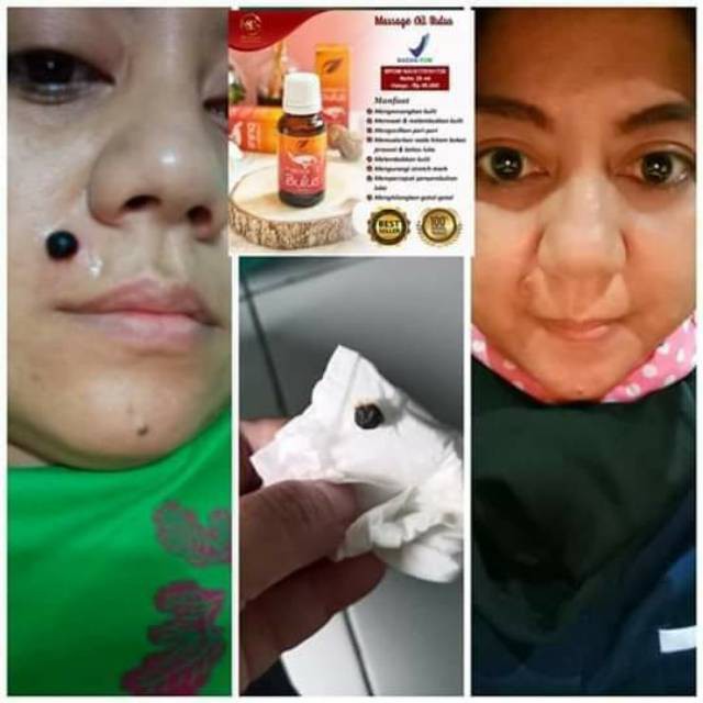 OBAT PENGHILANG TAHI LALAT OBAT PENGHILANG TAHI LALAT HIDUP OBAT PENGHILANG TAHI LALAT DAN KUTIL