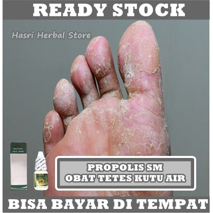 Obat Tetes Kutu Air - Obat Kutu Air di Kaki, Obat Kutu Air Ruam dan Gatal, Obat Jamur Kutu Air, Obat Penghilang Kutu Air di Kaki dan Tangan, Obat Kutu Air Original, Obat Kutu Air di Tangan, Obat Kutu Air Pada Telapak Kaki Dengan Herbal Propolis SM ASLI