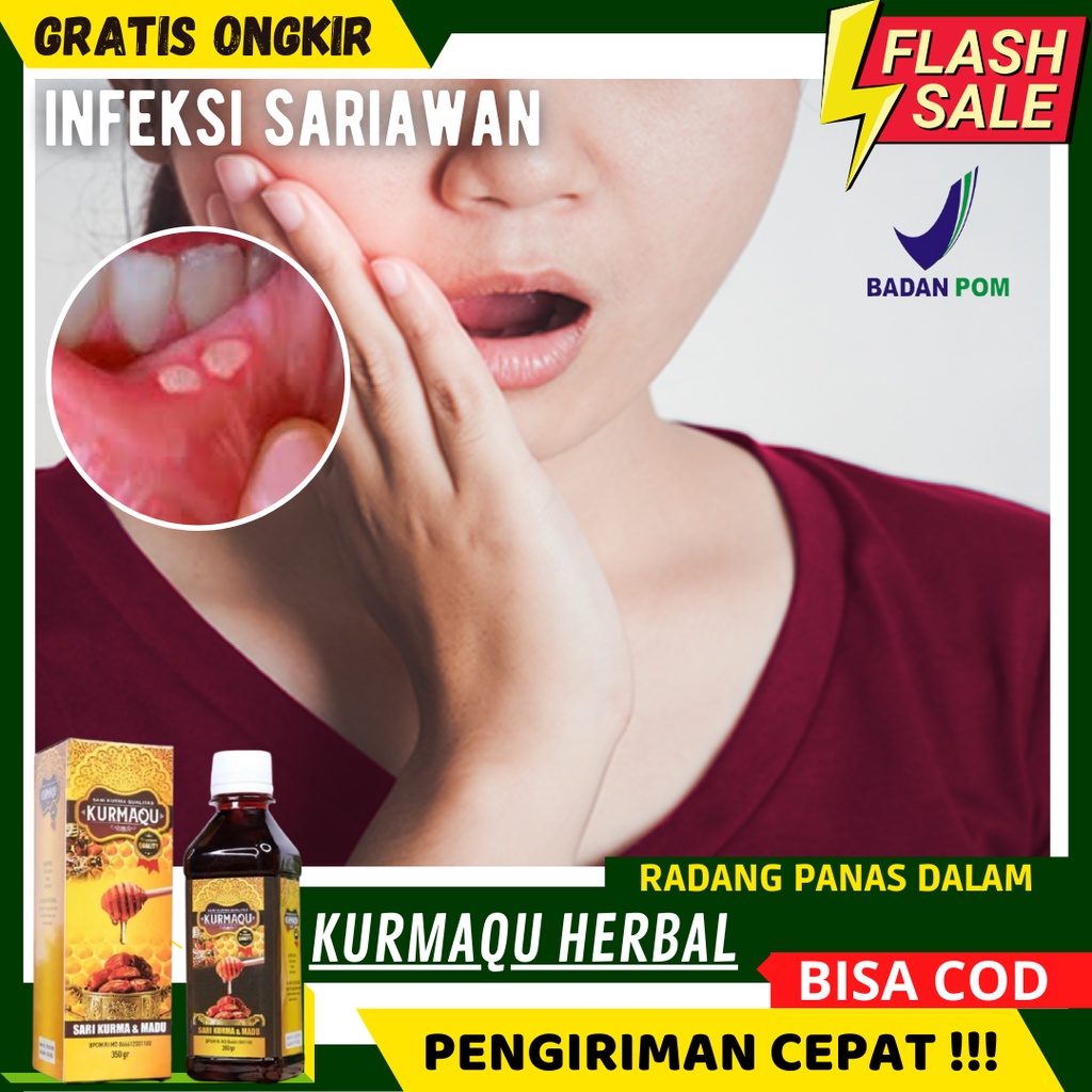 obat sariawan anak 2 tahun-obat sariawan anak 1 tahun-sariawan di pipi bagian dalam-obat sariawan di