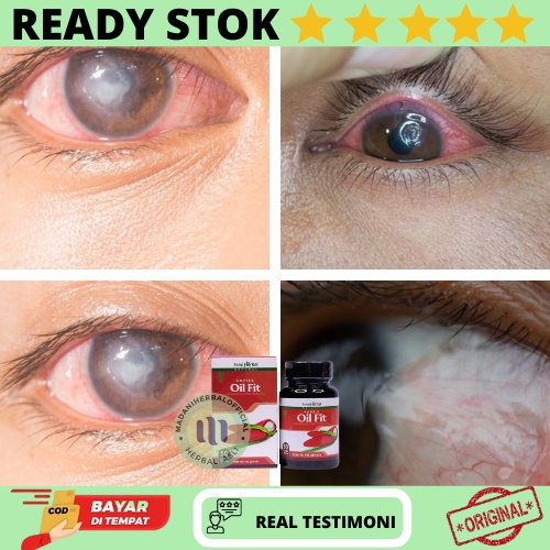 Obat Ulkus Kornea, Obat Penghilang Mata Terasa Mengganjal/Gatal, Obat Peradangan pada Mata, Menghila