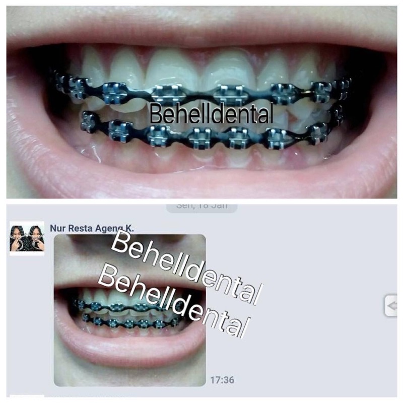 PAKET BEHEL PERMANEN METAL ORTHO BRACKET PROTECT USA ROTH WITH HOOK - Braces Dental Protek Proteck Untuk Perbaikan / Perawatan Gigi - Kawat Orthodontic Metalic - Behelldental