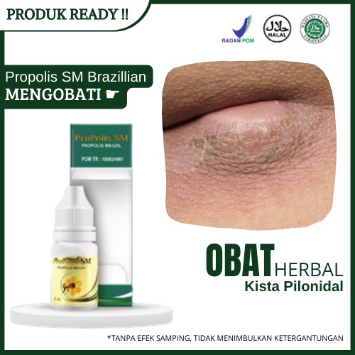 Obat Kista Pilonidal, Infeksi Kulit Kronis Di Lipatan Bokong, Pengempis Benjolan Di Tulang Ekor, Ben