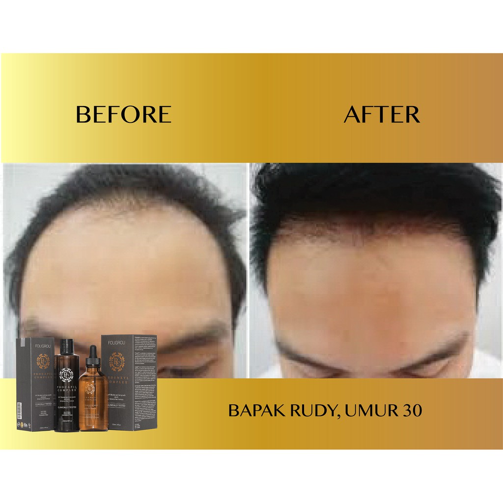 Foligrou Penumbuh Rambut