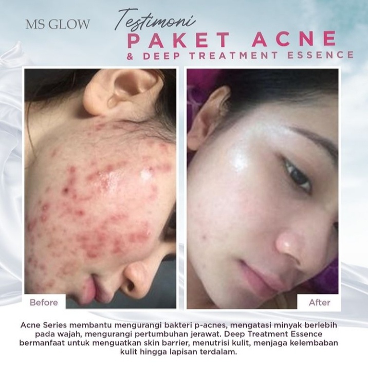 MS GLOW SKINCARE PAKET ACNE SERIES UNTUK KULIT BERJERAWAT AMPUH TERMURAH