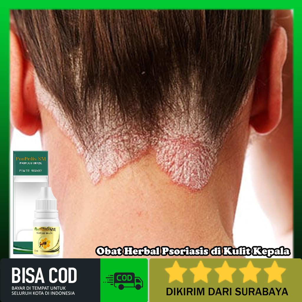 Obat Herbal Psoriasis di Kulit Kepala, Kuku, Jari Tangan dan Kaki, Wajah / Muka Propolis SM Terbaik