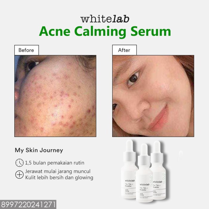 Whitelab WL Acne Calming Serum menghilangkan jerawat