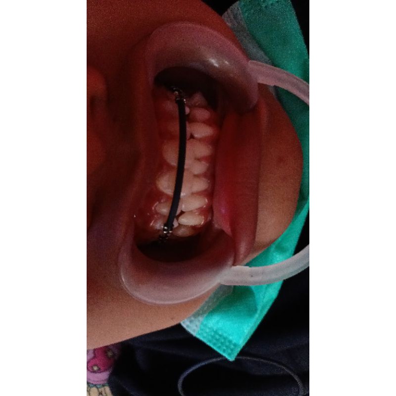 Behel thailand tailan original 100% kawat ori behel thailand