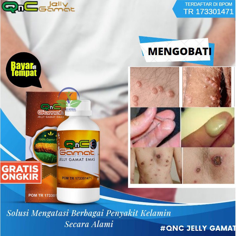 Gambar penyakit fistula ani