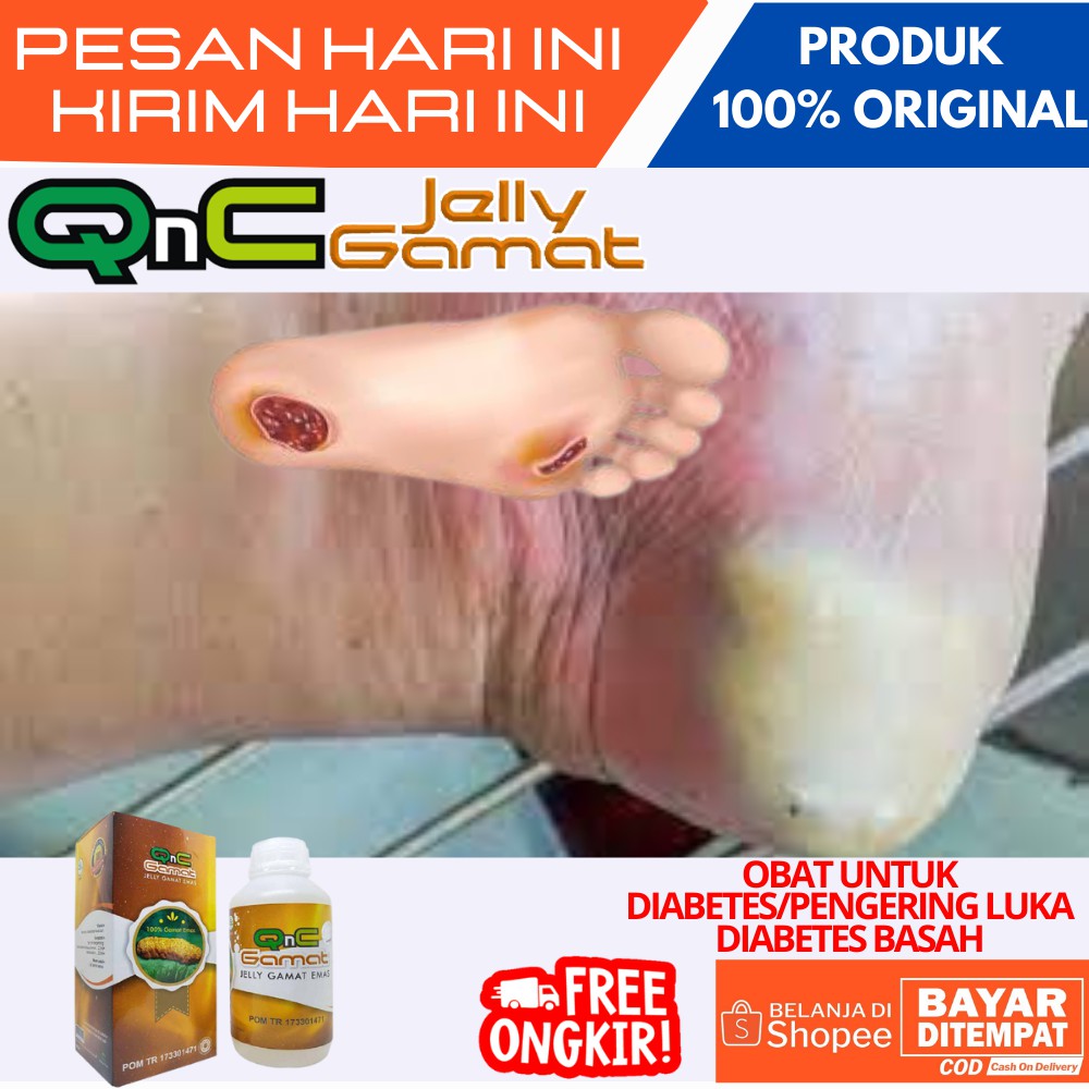 Obat Herbal Diabetes Basah,Obat Pengering Luka Diabetes Basah,Pengering Luka Diabetes Di Kaki