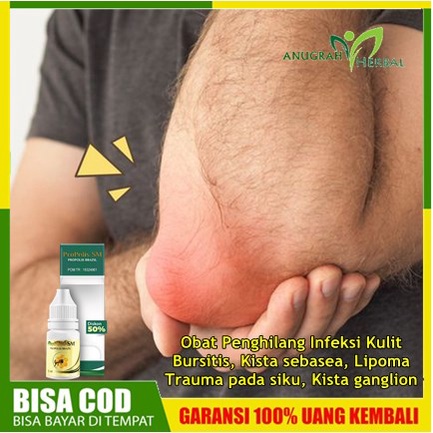 Timbulnya Benjolan di Siku Tangan Anak - Dewasa, Obat Penghilang Infeksi Kulit, Bursitis, Kista seba