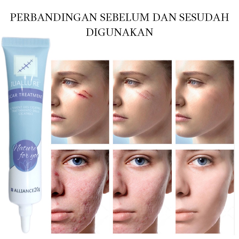 Krim Cream Salep penghilang luka bekas Menghilangkan stretch mark 20G Penghilang bekas luka yang ampuh Memperbaiki bekas luka bakar Bekas Jerawat Bekas luka lama Benjolan dan jerawat