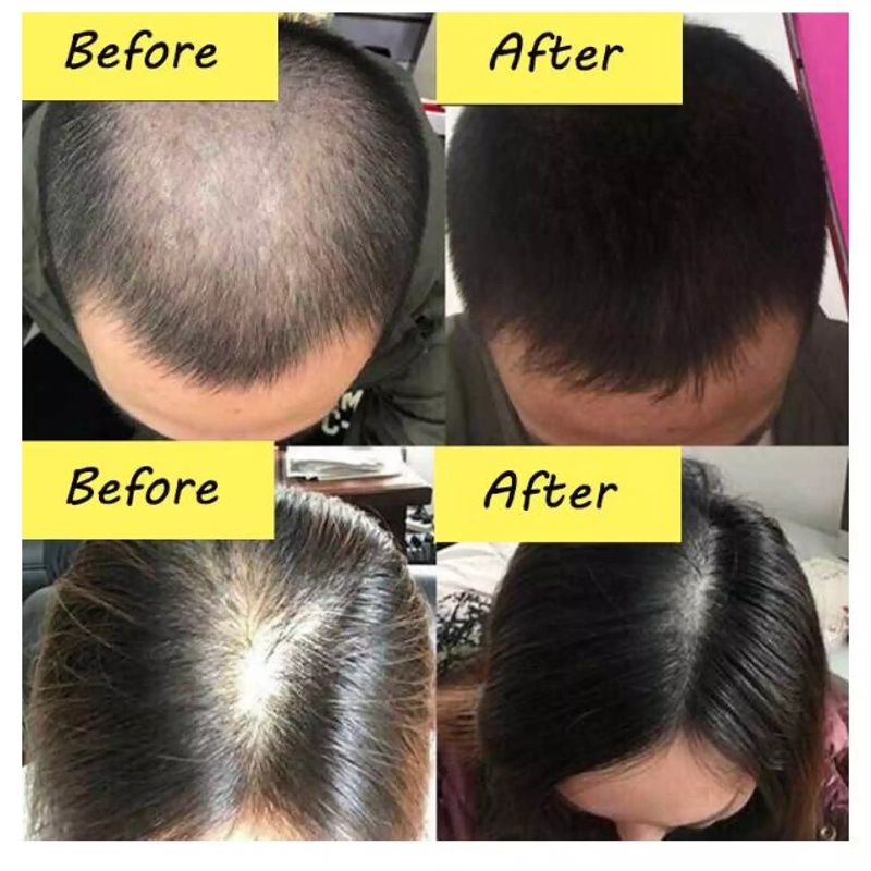 Serum Rambut Rontok Perawatan Rambut Rontok  30ml  Semprotan Pertumbuhan Rambut Memelihara akar rambut dan memperbaiki