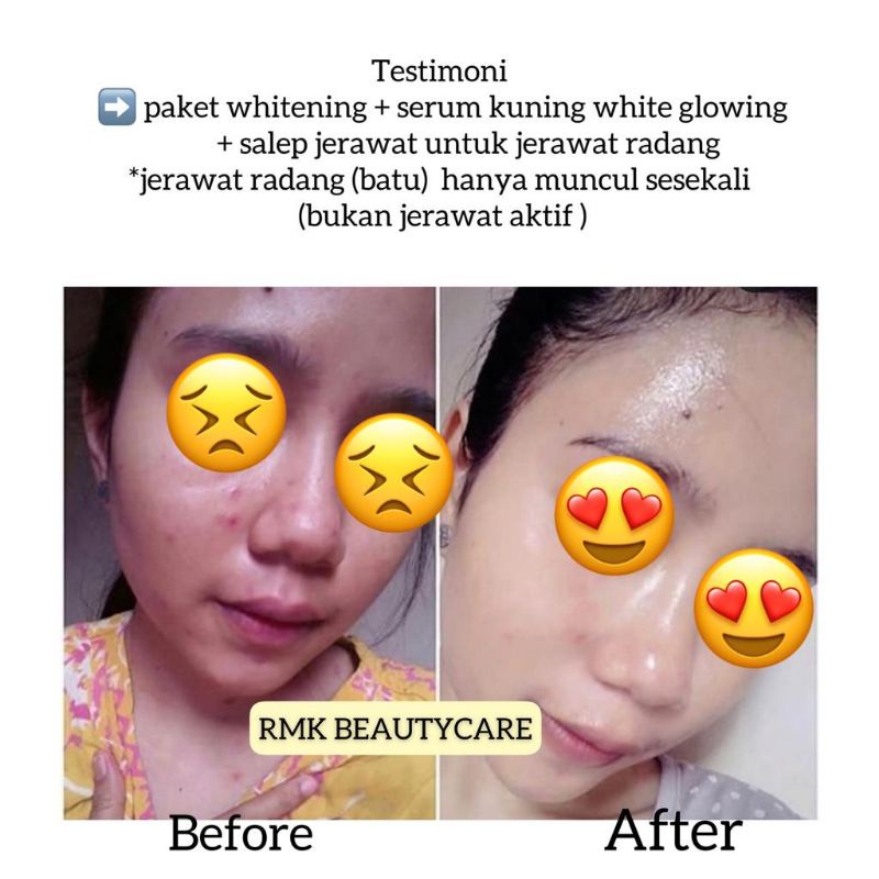 paket acne whitening cream jerawat radang jerawat bruntusan RMK