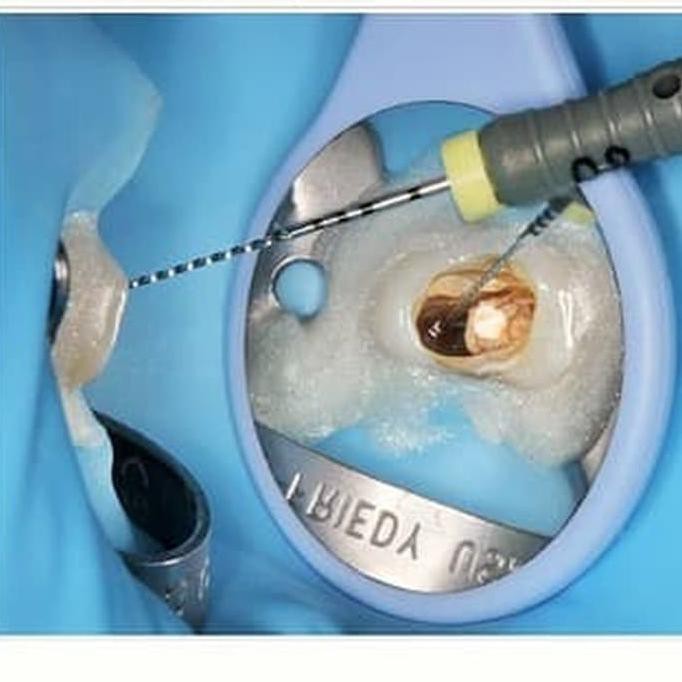 DENTAL MIRROR FRONT SURFACE / KACA MULUT ANTI FOG / ANTI EMBUN AUTOCLAVABLE