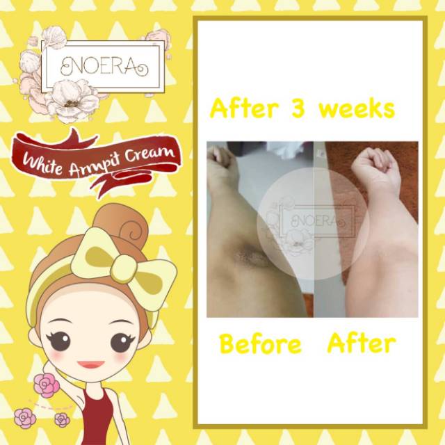 ✨ AKU MURAH ✨Noera Skin Lightening Cream Underarm // Pencerah Lipatan Penghilang Bekas Luka Underarm Cream BPOM
