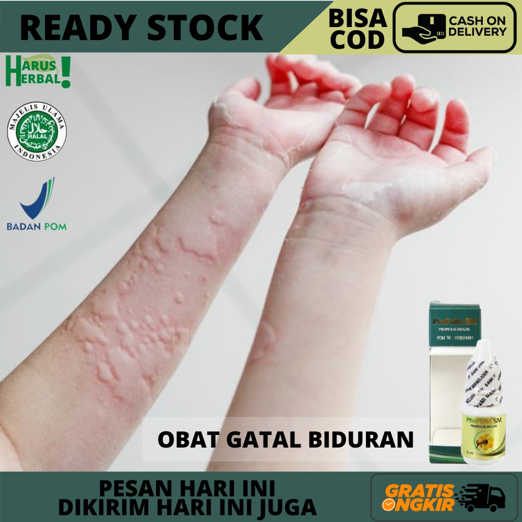 Obat Biduran, Obat Gatal Biduran, Obat Oles Biduran, Obat Biduran Menahun, Obat Biduran Kronis, Obat