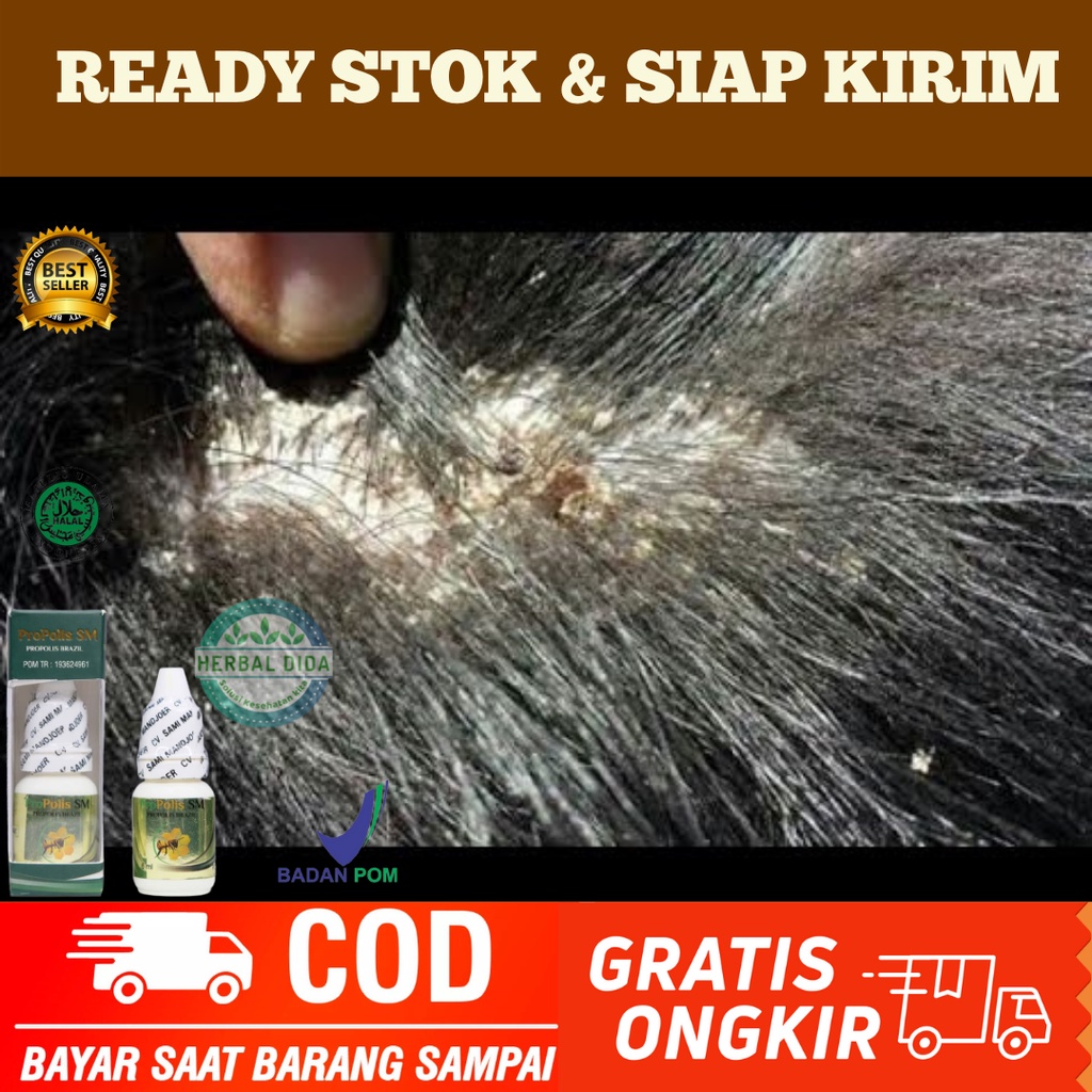 Obat Ketombe Parah Menahun, Obat Tetes Ketombe Parah, Obat Kulit Kepala Berkerak, Obat Ketombe Berke