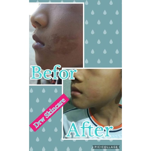 NEW ORIGINAL !!! COD Cream BEKAS LUKA/DermaBright By DRW SKINCARE