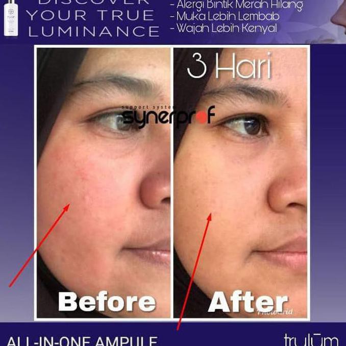 Obat Jerawat Ampuh Trulum Synergy Memutihkan Wajah Cepat Dan Aman Promo Special Shopee Indonesia
