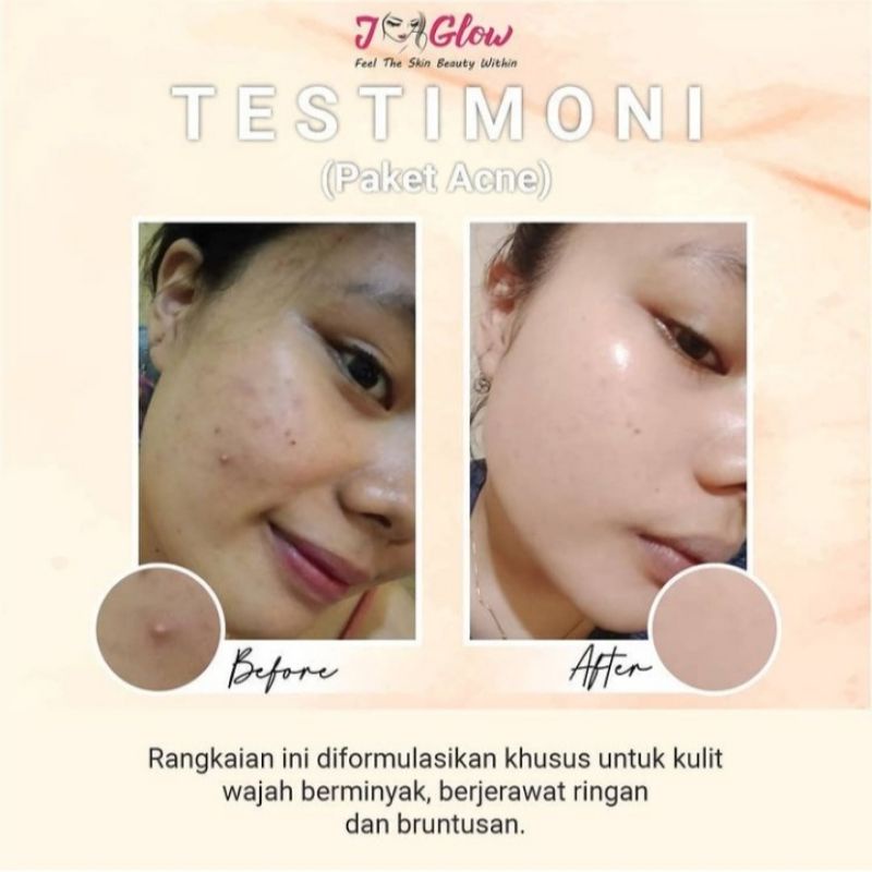 Jglow Skincare Paket Acne Whitening Glowing Skin / Paket Jerawat / Perawatan Wajah Bpom Original-3