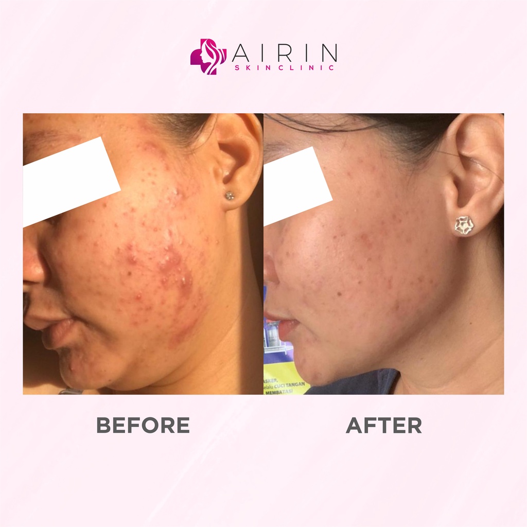 Airnderm Aesthetic Paket Acne Action FREE POUCH (by AIRIN BEAUTY)-8