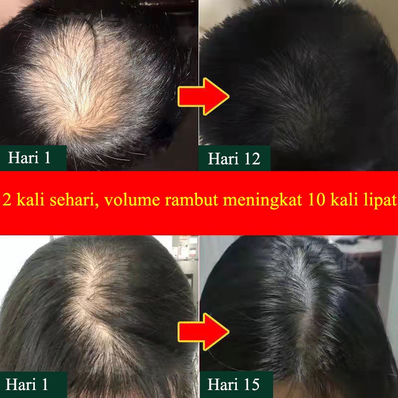 penumbuh rambut serum 30ml hair care Cepat dan efektif anti kebotakan/pertumbuhan rambut/perawatan kulit kepala/penebalan rambut