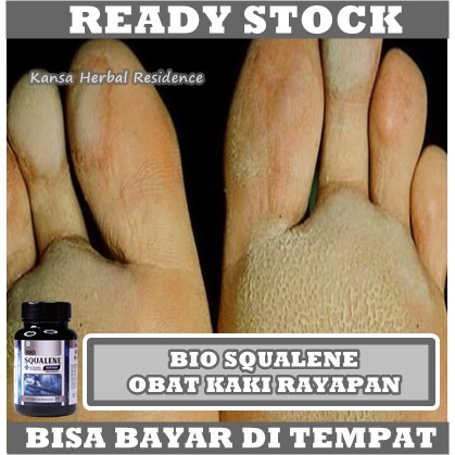 Obat Telapak Kaki Bolong Bolong, Obat Pitted Keratolysis, Obat Kaki Rayapan, Obat Kaki Bolong Bolong