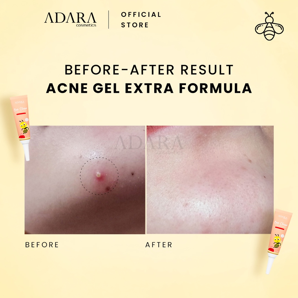 ADARA - Bee Clear Acne Gel Extra Formula