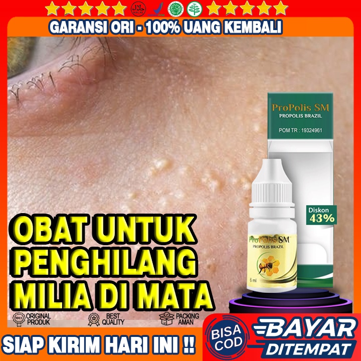 Obat Hilangkan Penyakit Milia Pada Wajah, Milia di Mata, Penghilang Milia di Wajah, Brutusan Di Mata