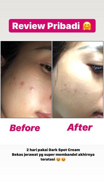 PROMO MURAH DARK SPOT( ANTI FLEK)