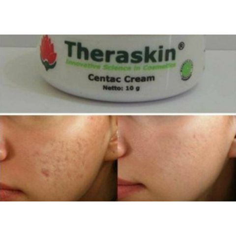 Theraskin centac cream