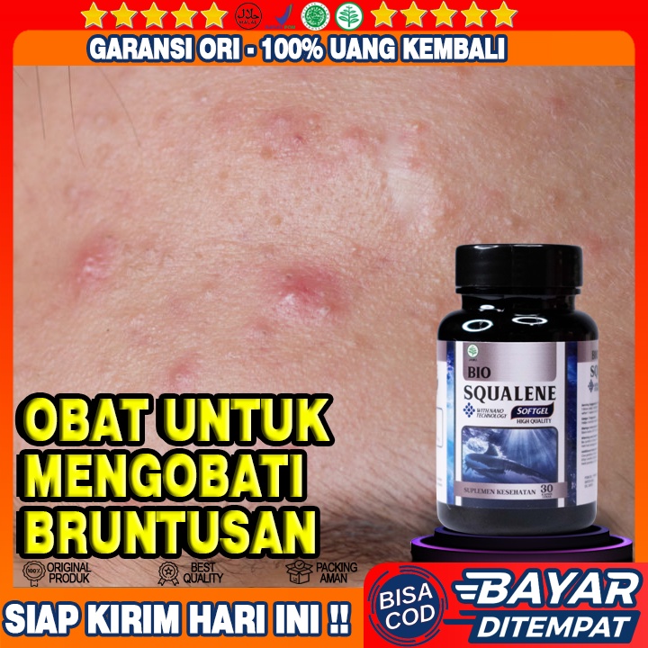 Obat Kulit Bruntusan Pada Dahi & di Wajah - Obat Gatal Bruntusan Pada Wajah -  Membersihkan Bruntusa