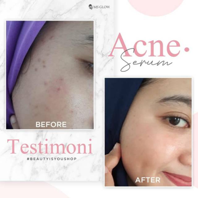 Ms Glow Serum Acne Original