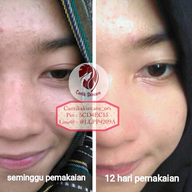 Paket wajah Acne Ms Glow by Cantikskincare ready stock