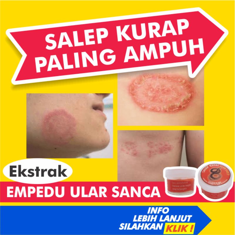 Salep Obat Kurap Kudis Paling Ampuh Gatal Kadas Gatel Eksim Kering Jamur Kulit Selangkangan Luka Dia