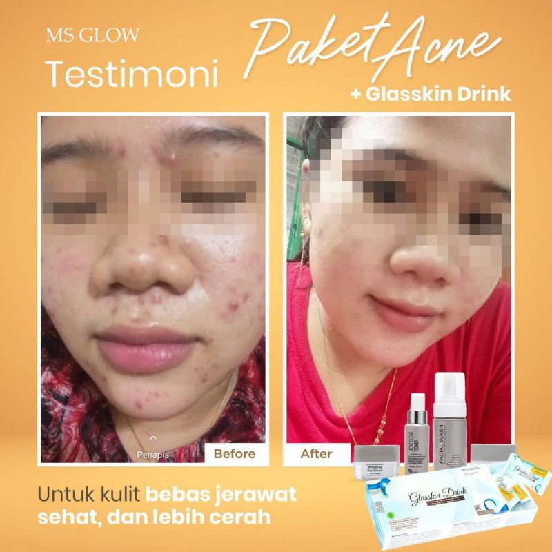 Ms Glow Paket Acne Free Pouch