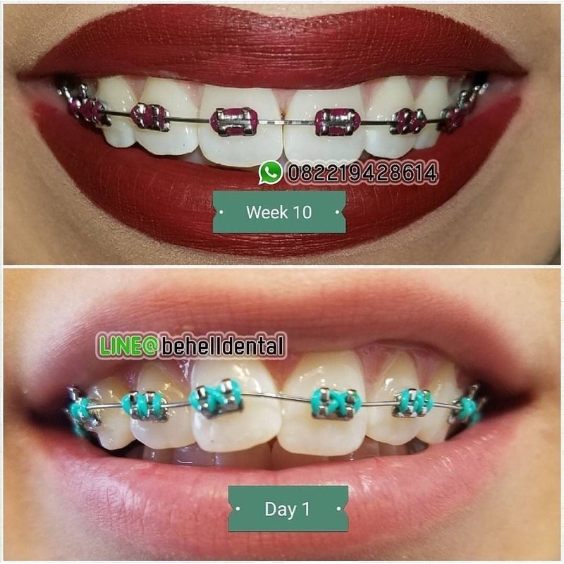 ORIGINAL PAKET BEHEL GIGI PERMANEN BRACKET EURODONTICS EURO METAL WITH HOOK 3 ROTH / BEHEL DENTAL KAWAT Untuk PERAWATAN PERBAIKAN Gigi - Ortho Orthodontic Eurodontic Behelldental
