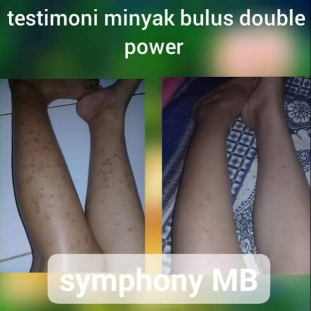 

SABUN DAN MINYAK PENGHILANG LUKA/BEKAS LUKA/FLEK HITAM