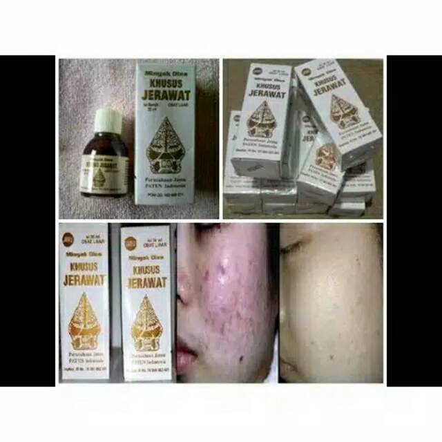 Minyak wayang khusus jerawat obat jerawat obat buat jerawat obat komedo obat bopeng wajah