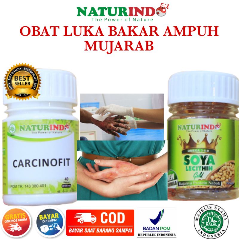 OBAT LUKA BAKAR LUKA KORENG LUKA GUDIK AMPUH MUJARAB