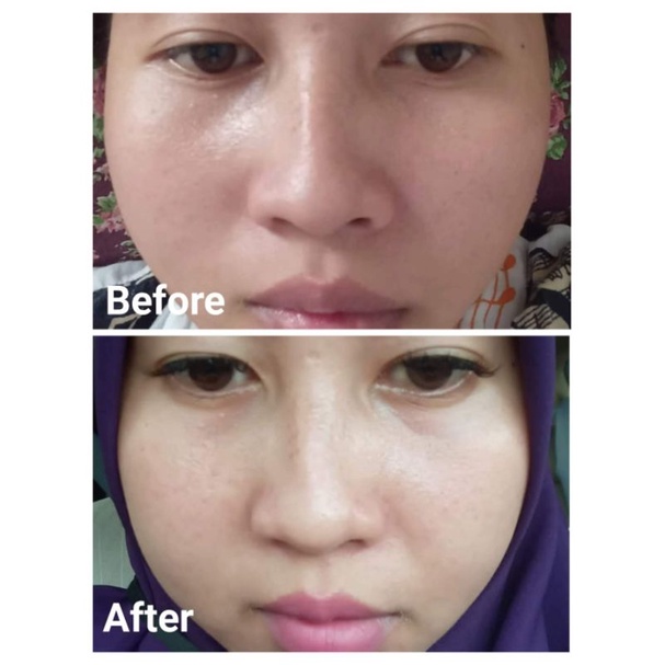 TESTI SHINESKIN SKINCARE KULIT BERMINYAK KUSAM FLEK HITAM