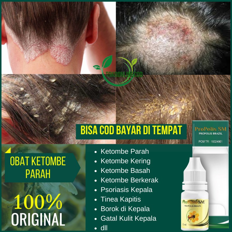 Obat Ketombe Rambut - Ketombe Kering - Ketombe Parah - Gatal Ketombe di Kulit Kepala - Propolis SM