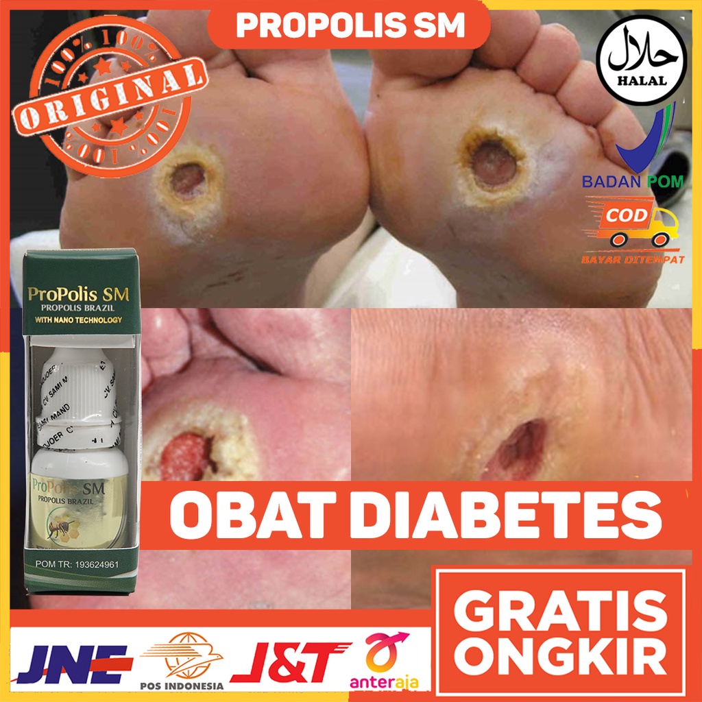 Obat Diabetes - Obat Diabetes Kering - Obat Diabetes Basah - Obat Diabetes Menahun - Obat Sakit Diab