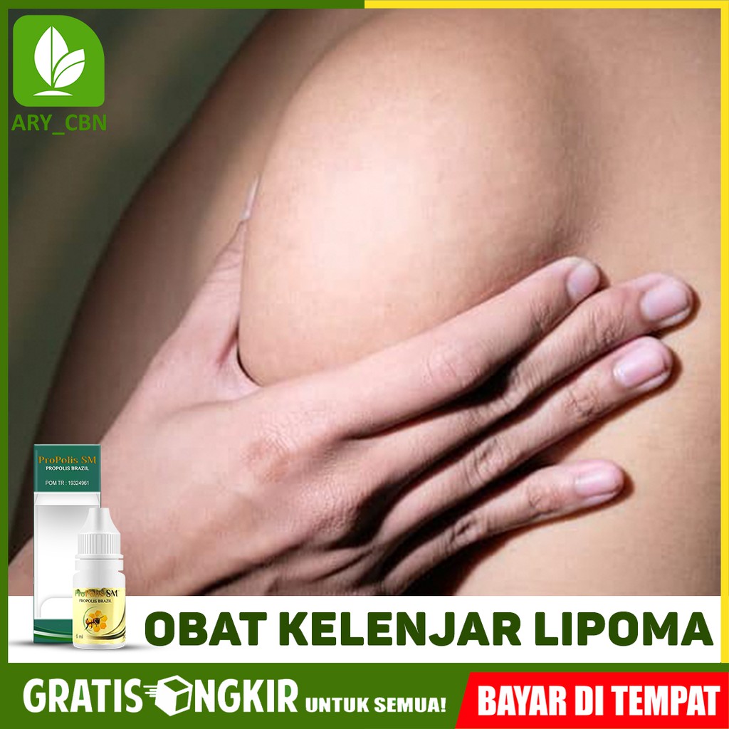 

Obat Kelenjar Lipoma Benjolan Lipoma Tanpa Operasi Herbal Propolis SM Brasil Bisa COD Di Cirebon